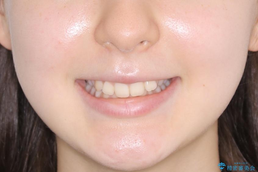 【非抜歯】前歯のガタつきを改善　笑顔の印象も変わる!の治療前（顔貌）