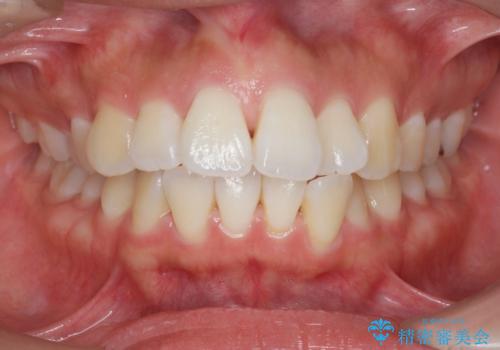 [ マウスピース矯正 ]  出っ歯に見える前歯を改善したいの症例 治療前