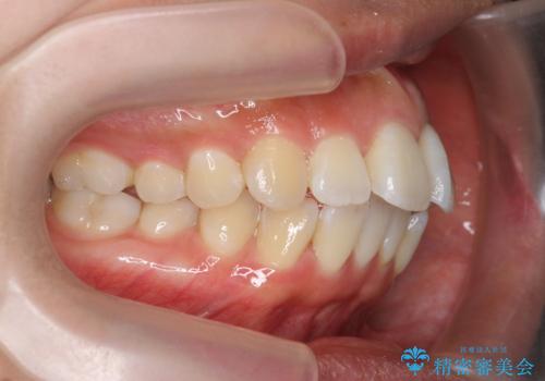 [ マウスピース矯正 ]  出っ歯に見える前歯を改善したいの治療前