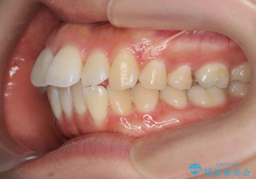 [ マウスピース矯正 ]  出っ歯に見える前歯を改善したいの治療前