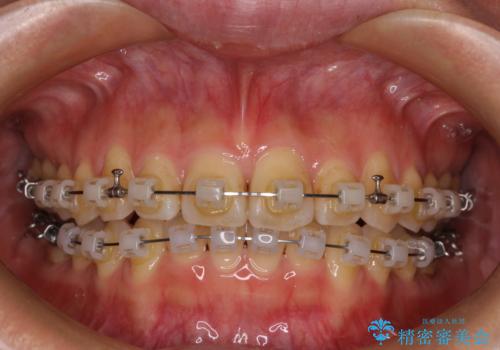 手間をかけずに治したい 短期間のワイヤー矯正の治療中