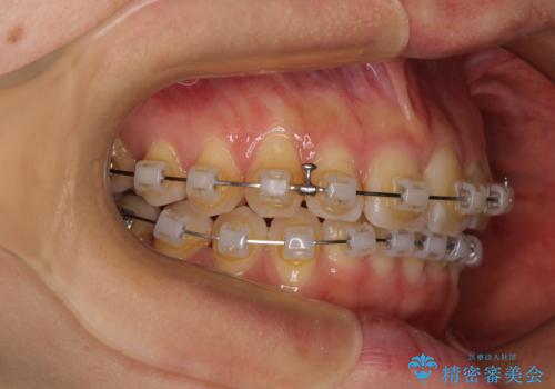 手間をかけずに治したい 短期間のワイヤー矯正の治療中
