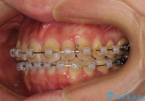 手間をかけずに治したい 短期間のワイヤー矯正の治療中