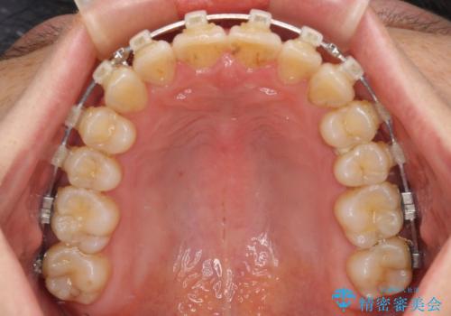 手間をかけずに治したい 短期間のワイヤー矯正の治療中