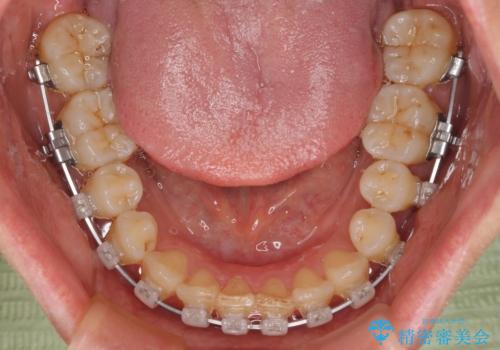 手間をかけずに治したい 短期間のワイヤー矯正の治療中