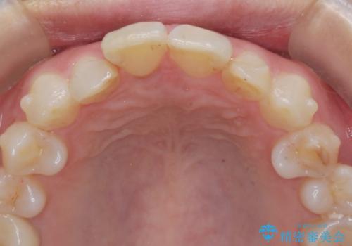 インビザラインで行う前歯のみの部分矯正の治療中