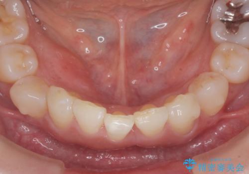 インビザラインで行う前歯のみの部分矯正の治療中