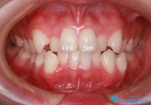 【抜歯インビザ】前歯の凸凹をなおしたいの治療前