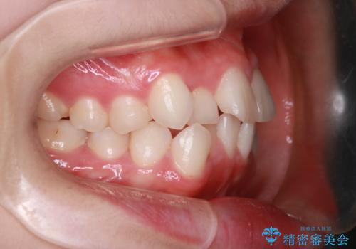 【抜歯インビザ】前歯の凸凹をなおしたいの治療前