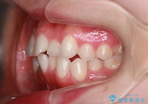 【抜歯インビザ】前歯の凸凹をなおしたいの治療前