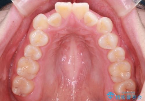 【抜歯インビザ】前歯の凸凹をなおしたいの治療前