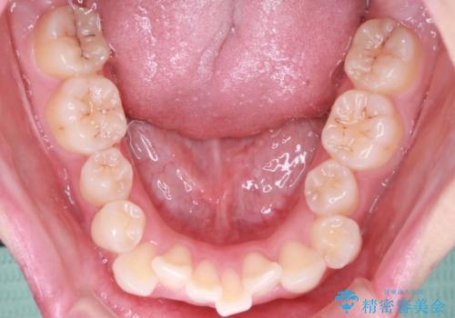 【抜歯インビザ】前歯の凸凹をなおしたいの治療前