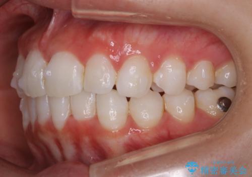 【非抜歯】歯軸を治して正しい噛み合わせへの治療中