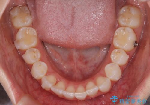 【非抜歯】歯軸を治して正しい噛み合わせへの治療中