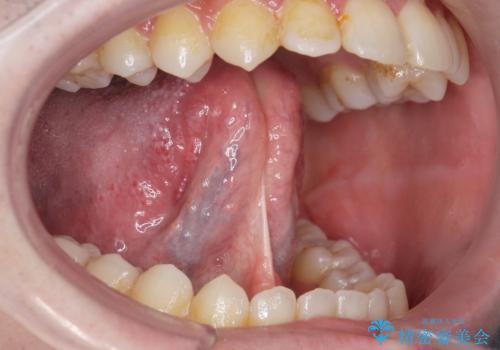 舌が動かしにくいの治療前