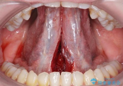 舌が動かしにくいの治療中