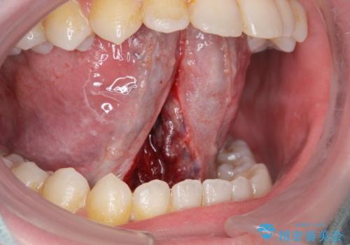 舌が動かしにくいの治療中