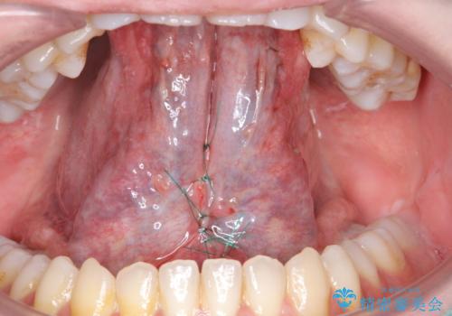舌が動かしにくいの治療中