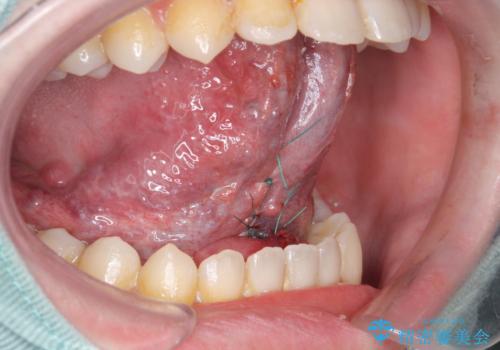 舌が動かしにくいの治療中
