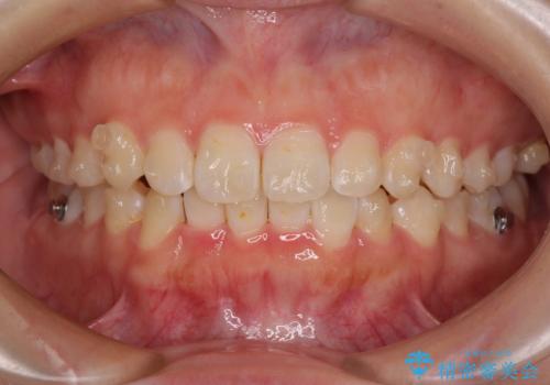 前歯のデコボコを整える インビザラインによる矯正治療の治療中