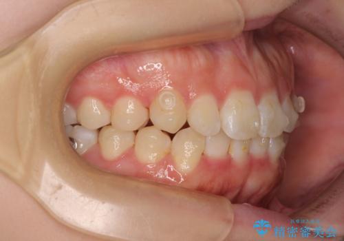 前歯のデコボコを整える インビザラインによる矯正治療の治療中