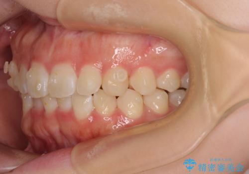 前歯のデコボコを整える　インビザラインによる矯正治療の治療中