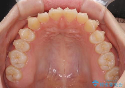 前歯のデコボコを整える インビザラインによる矯正治療の治療中