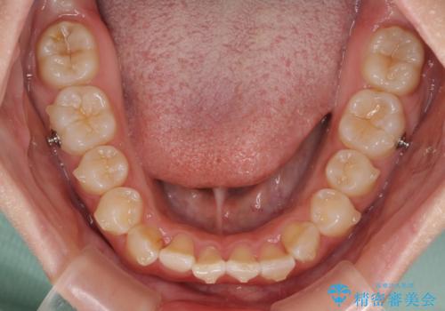 前歯のデコボコを整える　インビザラインによる矯正治療の治療中