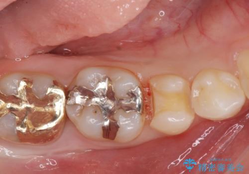 レントゲンで見つかった歯と歯の間の虫歯をセラミックインレーで修復の治療中