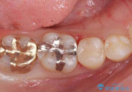 レントゲンで見つかった歯と歯の間の虫歯をセラミックインレーで修復の治療後