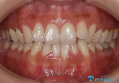 【非抜歯】歯を抜かなくても短期間でキレイな歯並びにの症例 治療前