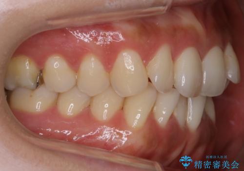 【非抜歯】歯を抜かなくても短期間でキレイな歯並びにの治療前