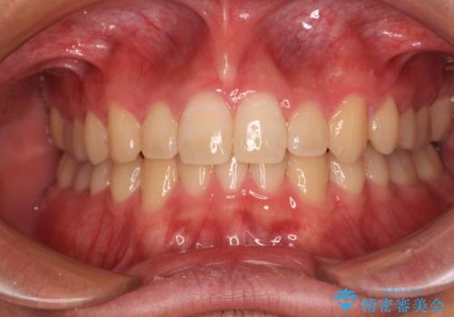 欠損した前歯とディープバイト　ワイヤー矯正で短期間で治療の症例 治療後