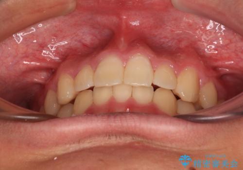 欠損した前歯とディープバイト ワイヤー矯正で短期間で治療の治療後