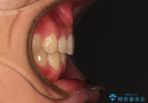 欠損した前歯とディープバイト ワイヤー矯正で短期間で治療の治療後