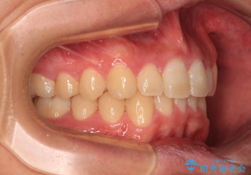 欠損した前歯とディープバイト　ワイヤー矯正で短期間で治療の治療後