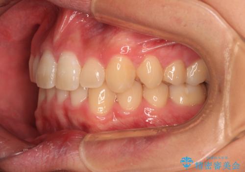 欠損した前歯とディープバイト　ワイヤー矯正で短期間で治療の治療後