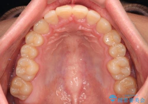 欠損した前歯とディープバイト ワイヤー矯正で短期間で治療の治療後