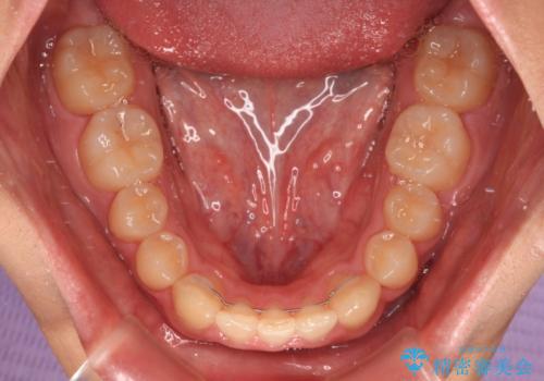 欠損した前歯とディープバイト ワイヤー矯正で短期間で治療の治療後