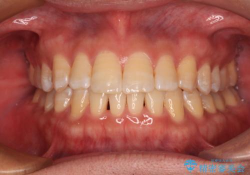 【モニター】楽して治したい メタルブラケットによる矯正治療の症例 治療後