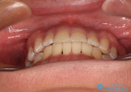 【モニター】楽して治したい メタルブラケットによる矯正治療の治療後