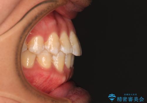 【モニター】楽して治したい メタルブラケットによる矯正治療の治療後