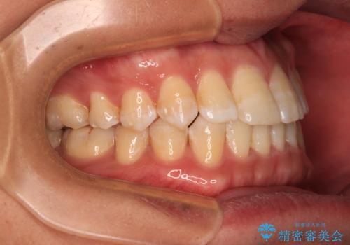 【モニター】楽して治したい メタルブラケットによる矯正治療の治療後