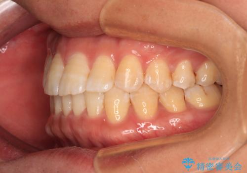 【モニター】楽して治したい メタルブラケットによる矯正治療の治療後