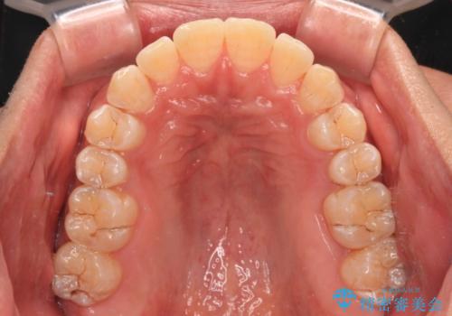【モニター】楽して治したい メタルブラケットによる矯正治療の治療後