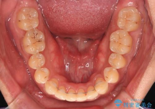 【モニター】楽して治したい メタルブラケットによる矯正治療の治療後