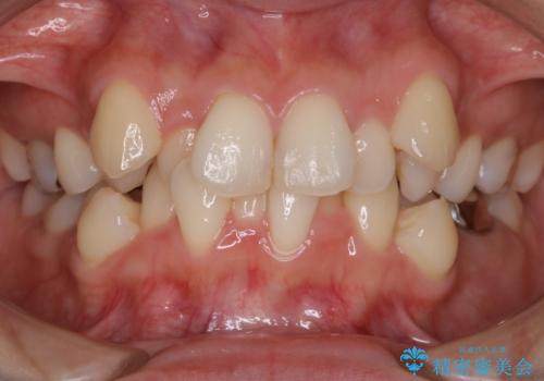 【抜歯】前歯のガタつきを改善　抜歯矯正で口腔内をスッキリさせるの症例 治療前