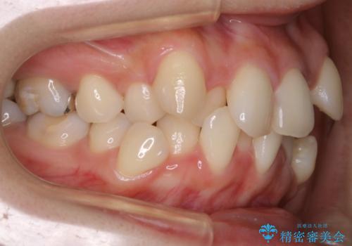 【抜歯】前歯のガタつきを改善　抜歯矯正で口腔内をスッキリさせるの治療前