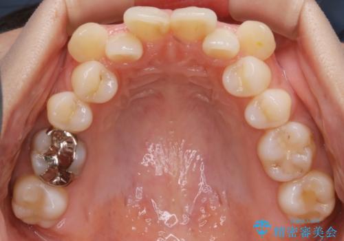【抜歯】前歯のガタつきを改善　抜歯矯正で口腔内をスッキリさせるの治療前