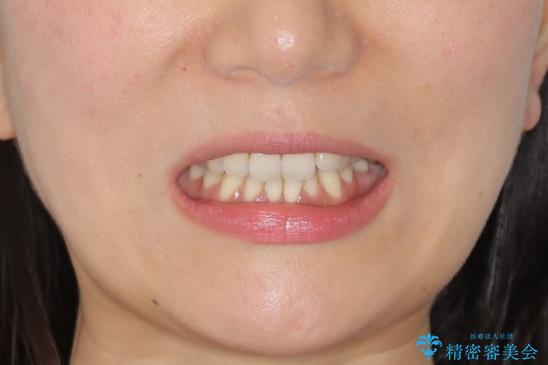 【非抜歯】歯を抜かなくても短期間でキレイな歯並びにの治療前（顔貌）